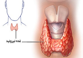 پمفلت پرکاری تیروئید